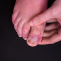 Red Spots on Your Foot? Here's Why Your Foot Has Red Spots and How to Treat Them