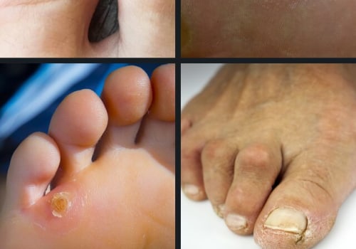 Expert Insights: The Top 10 Foot Disorders and How to Treat Them Effectively