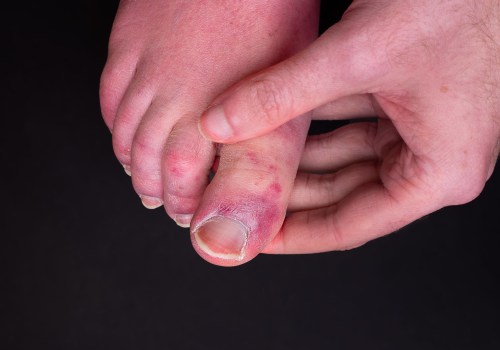 Red Spots on Your Foot? Here's Why Your Foot Has Red Spots and How to Treat Them